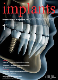implants Czech Republic No. 1, 2017