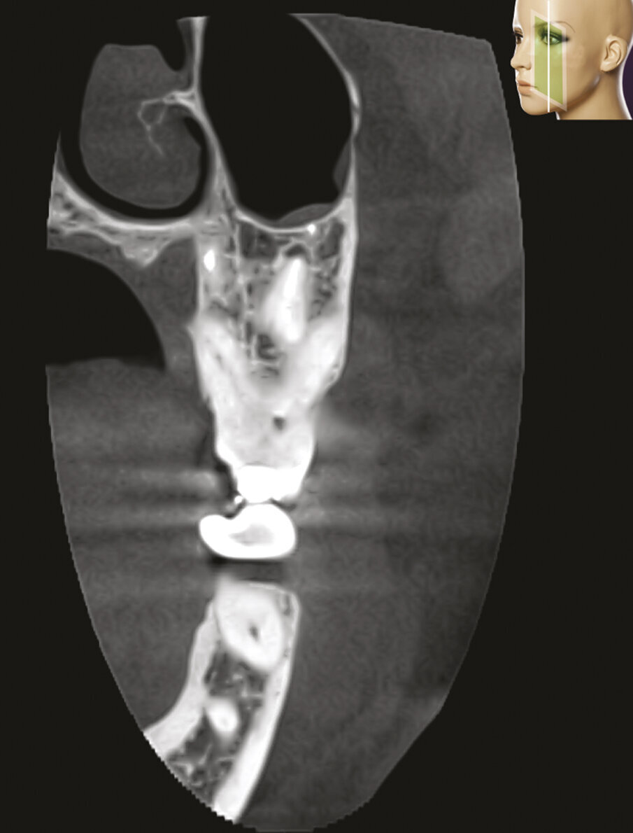 Fig. 2d - La sezione coronale mette in evidenza il fatto che la radice distovestibolare del primo molare è vestibolare alla radice mesiovestibolare del secondo molare.