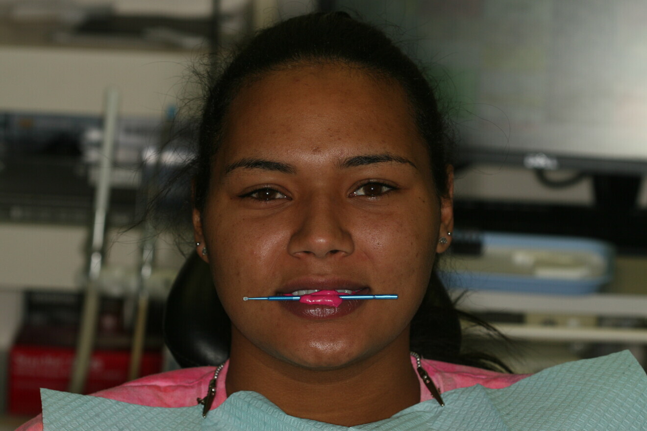 Fig. 7: Taking of the stick bite