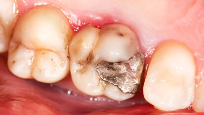 Studie zur Haltbarkeit von Restaurationen