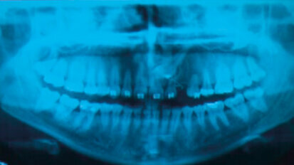 La terapia implantare, opzione terapeutica  per un canino incluso e il mantenimento  con approccio tailor-made: case report