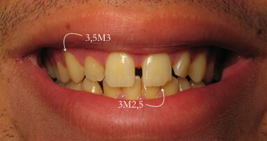 50 nuances de blanc, l’éclaircissement dentaire jour après jour