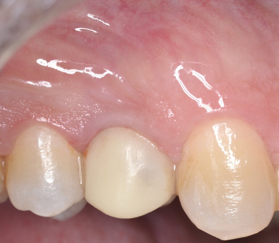 Fig. 20 - Aspetto dei tessuti molli al termine della guarigione (4 mesi).