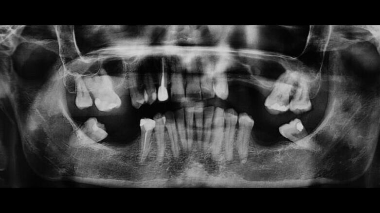 Tecniche e materiali nella riabilitazione implanto supportata per mezzo di Sinus Lift e GBR