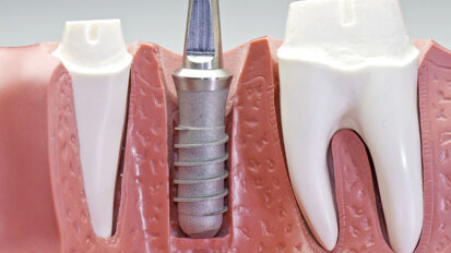 Strom soll Implantate von Bakterien befreien Strom soll Implantate von Bakterien befreien