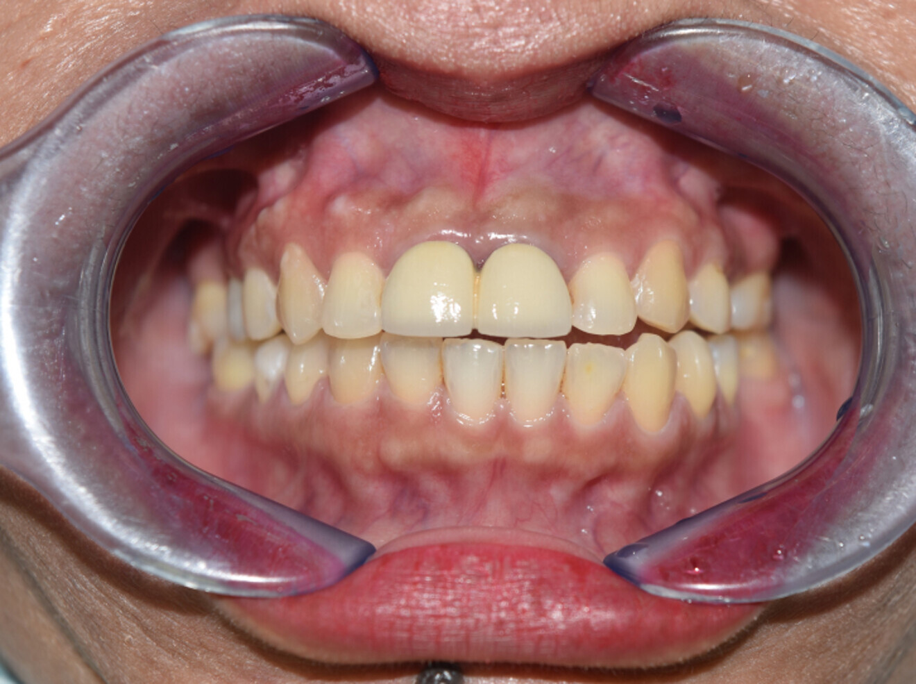 Fig. 13c: 4 years post orthodontic treatment.