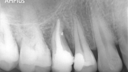 The DownPak device: Obturation with heat and vibration