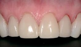 Afbeelding 9: Beeld direct postoperatief.