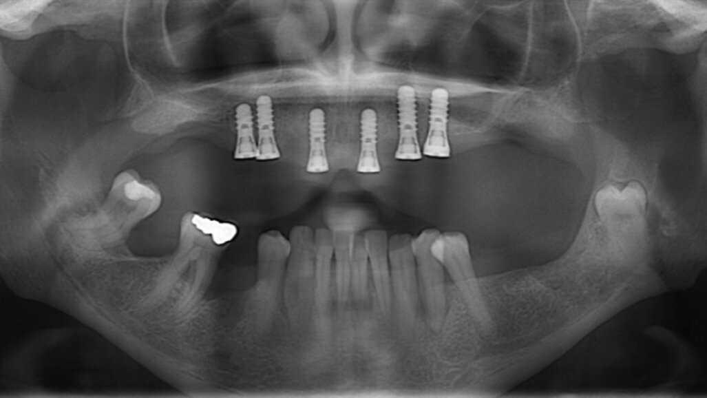 Fáze před ošetřením a význam stabilní parodontální situace