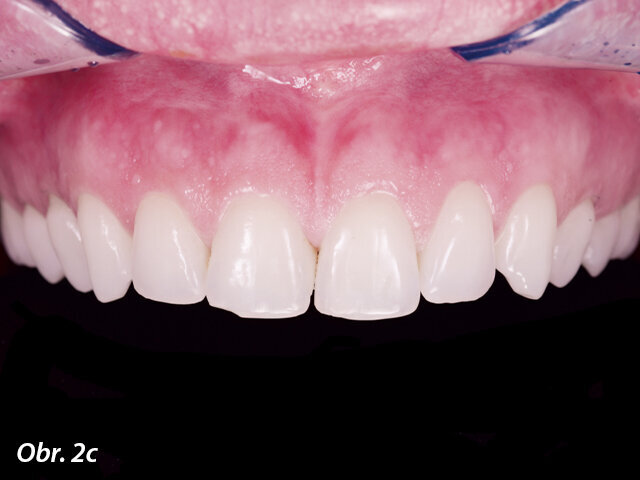 Cílem tohoto estetického ošetření bylo vylepšit úsměv pacientky. Při úpravě nebo korekci smile designu je však vedle všech základních estetických parametrů rovněž důležité zohlednit analýzu obličeje a osobnost pacientky, a to proto, aby bylo možno při současné minimální invazivitě vytvořit co nejpřirozenější personalizovaný smile design.