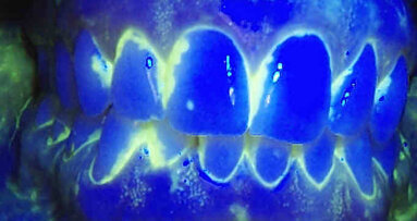 Effetto barriera dei sigillanti