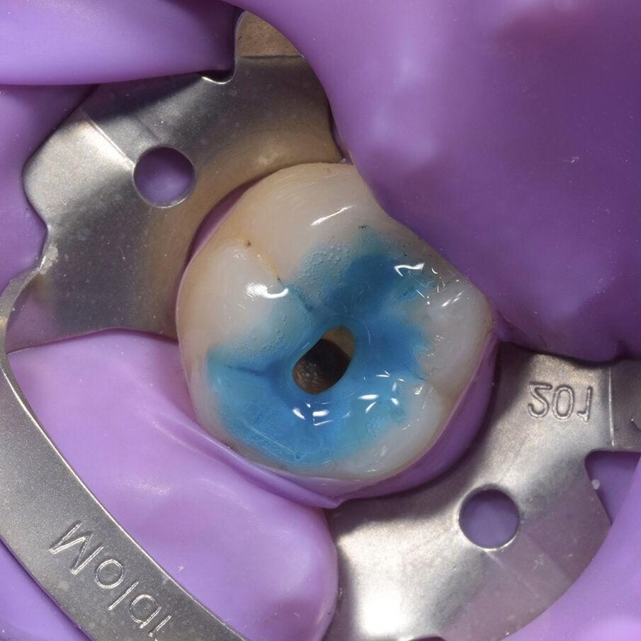 Fig 4: Etching and bonding with 35% phosphoric acid and Beautibond 