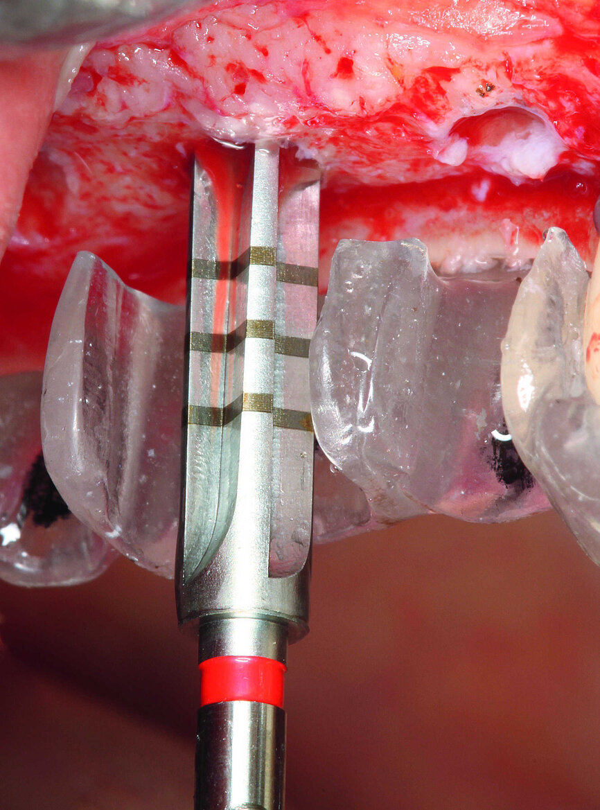 Fig. 8 : Foret d’extension rouge. 