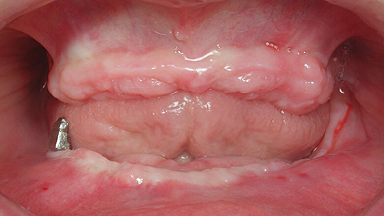 Rehabilitación con prótesis híbrida cerámica