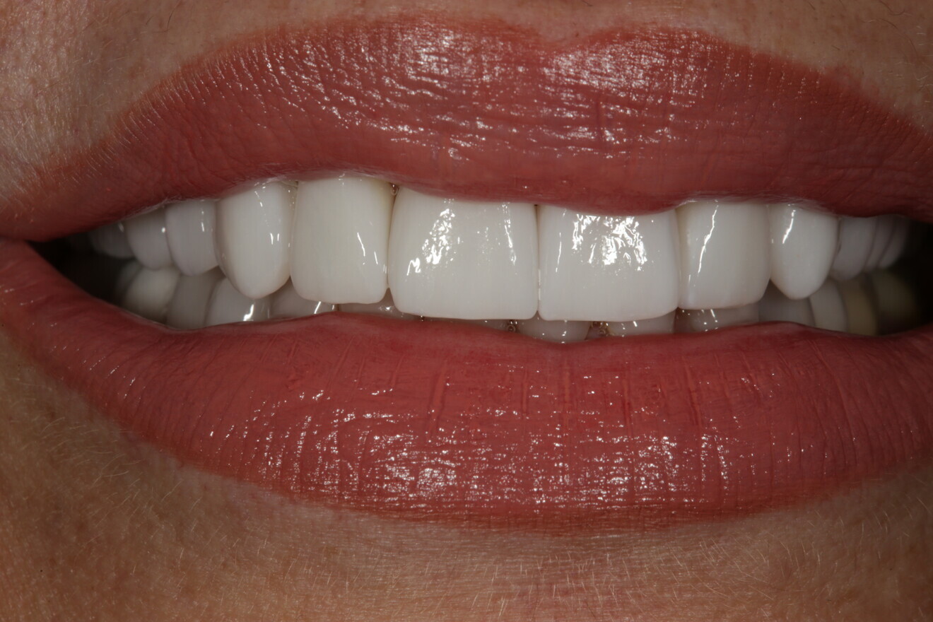 Fig. 23: Frontal view of the patient’s full smile once the case was completed.