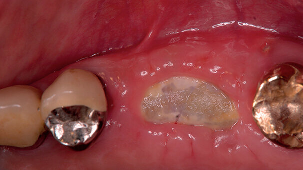 Procedure mininvasive d’aumento e preservazione alveolare (open barrier membrane technique)