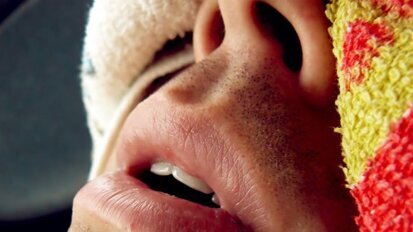 Obstructive Sleep Apnea (OSA) can lead to prosthetic complications in Dental Implants