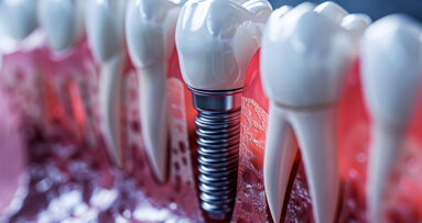 Regenerative Zahnmedizin: Biomaterialien bei der Sofortimplantation