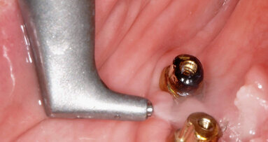 De la complicațiile implantelor la renaștarea lor.