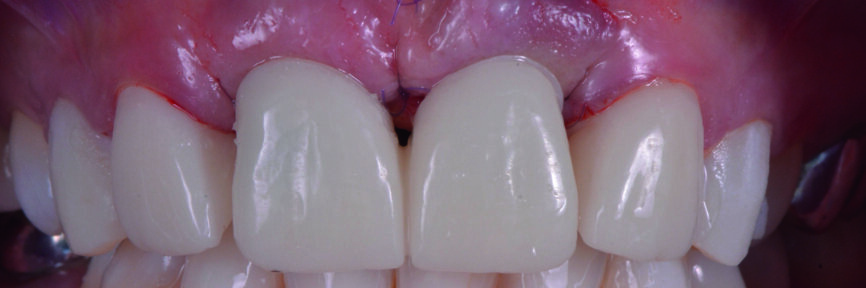 Figs. 21–23 : Restaurations provisoires vissées sur les implants. 