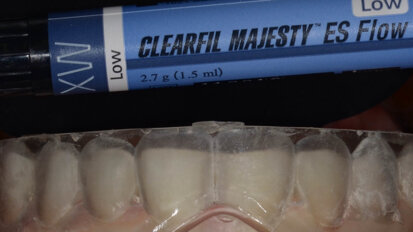 Fig. 4: For this case, it was decided to use CLEARFIL MAJESTY ES Flow Low in Shade XW (Kuraray Noritake Dental), the properties and flowability of which made it ideal for a case like this.