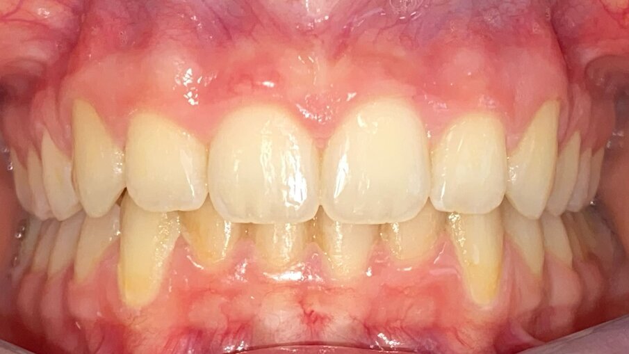 Fig. 18_Frontale post-trattamento.