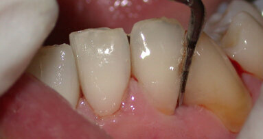 Come è cambiata la terapia parodontale non chirurgica