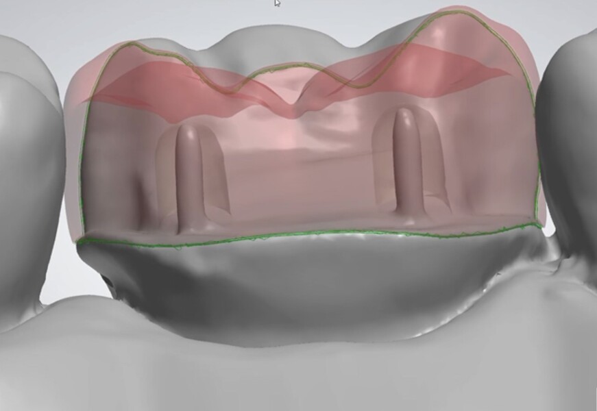 Fig. 15c: The restoration design superimposed on the preparation.