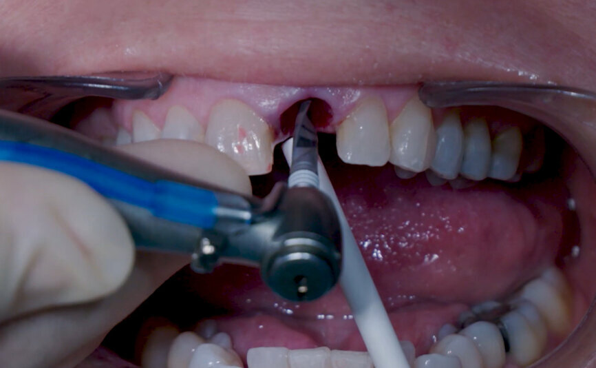 Fig. 8: Osteotomy with Ø 3.2 mm drill.