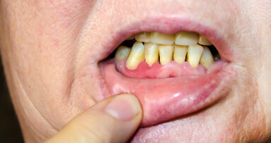 EFP and WHF release consensus report on links between periodontal and cardiovascular health