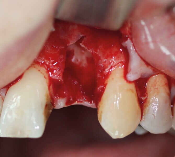 Fig. 20 : Destruction osseuse verticale en regard de la racine fracturée de 22.