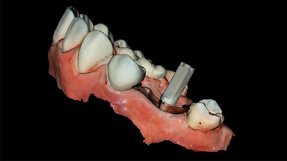 Digitální workflow a aplikace PRF a ozonové terapie v orální rehabilitaci