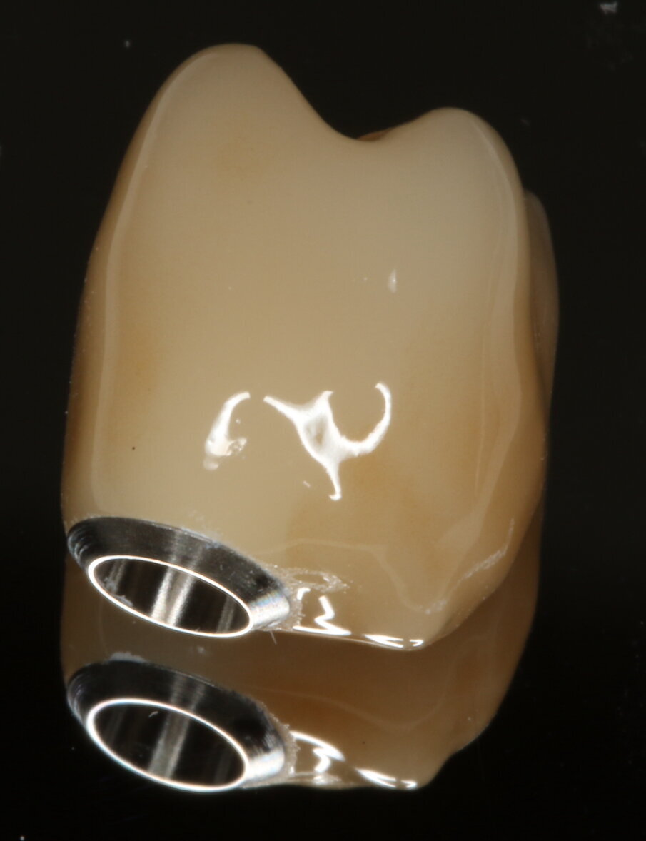 Fig. 10_Corona in disilicato di litio.