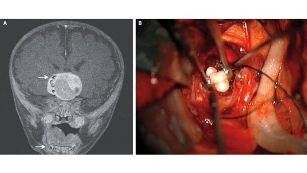 Baby heeft hersentumor met tanden