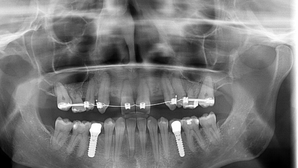Casus: complexe implantologiebehandeling