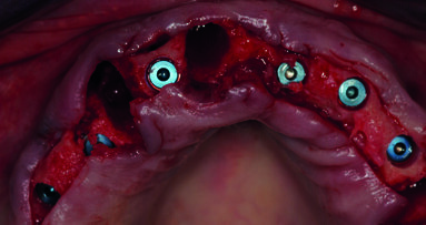 Il management della riabilitazione implanto-protesica nel paziente parzialmente edentulo