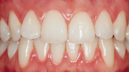 Riabilitazione estetica e funzionale dei settori posteriori con tecnica diretta e indiretta