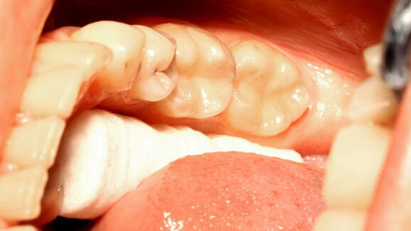 BPA kan in speeksel en urine terechtkomen