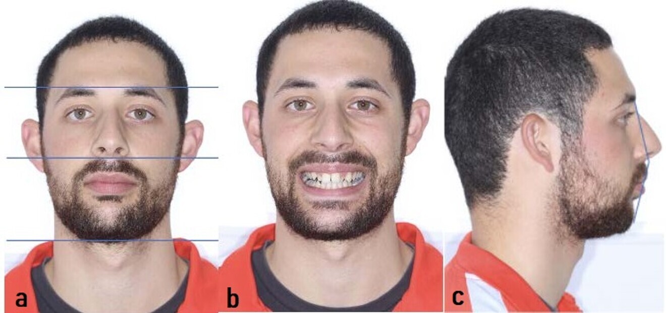 Figs. 1a–c: Initial extra-oral photographs. 