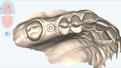 Scan, design and print: A complete digital workflow for implant-supported hybrid composite restorations