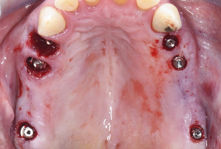 Fig. 3: Implants and immediately positioned MultiBase Abutments EV. 