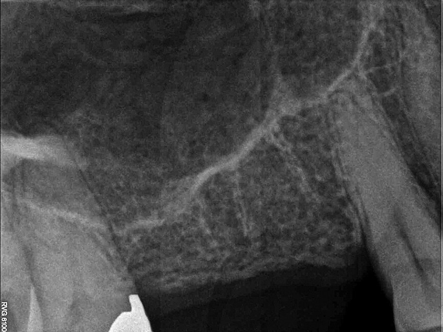 Fig. 2: Pre-op radiograph.