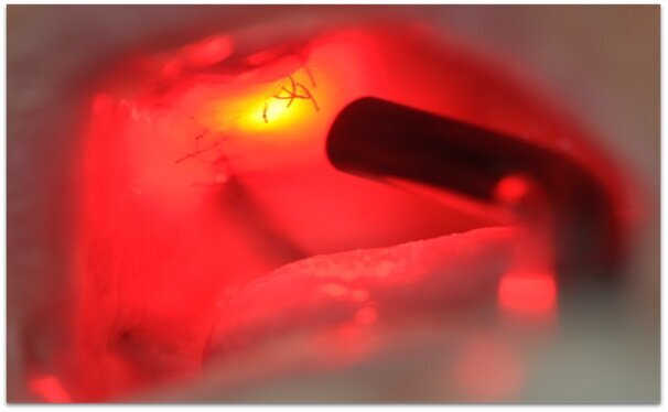 Ryc. 6_Fotobiomodulacja.