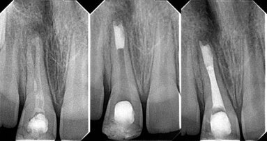 Revascularisation of the necrotic open apex
