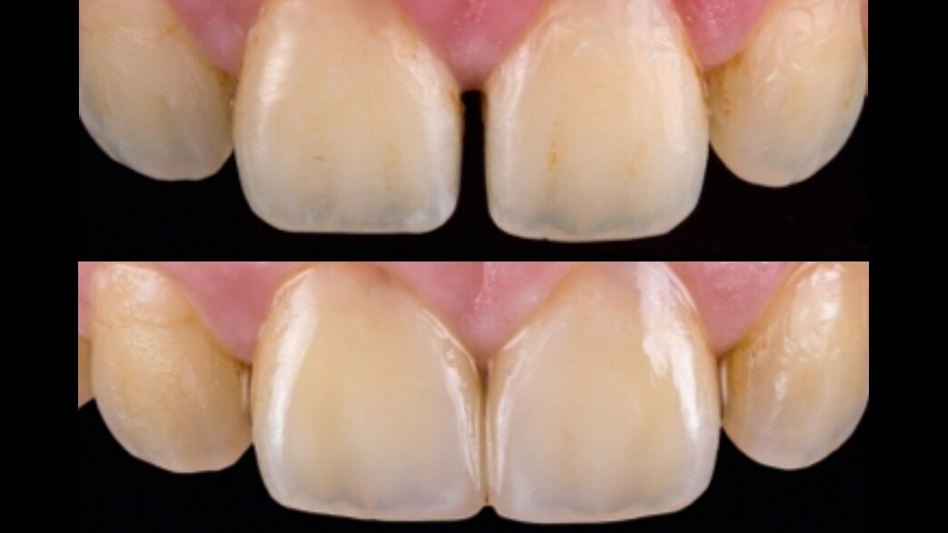 Restauración no invasiva con microcarilla de cerámica híbrida