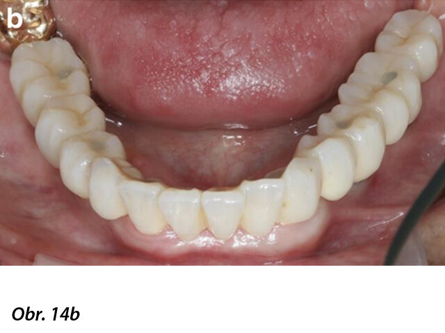 Zdravý stav periimplantátové sliznice a finální CAD/CAM náhrada bezprostředně po nasazení pacientce.
