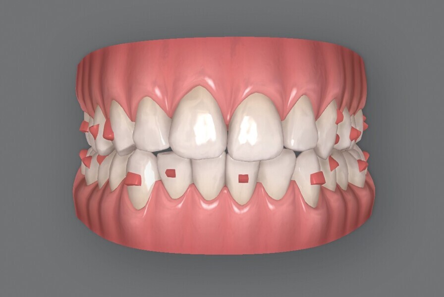 Fig. 5c : Plan supplémentaire du traitement par aligneurs conçu par ClinCheck (début). 