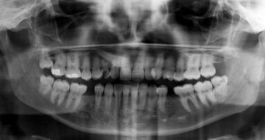 Immediate implant placement and immediate loading after a complicated tooth extraction