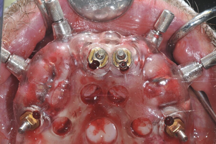 Fig. 4a_Visione occlusale degli impianti posizionati tramite dima chirurgica.