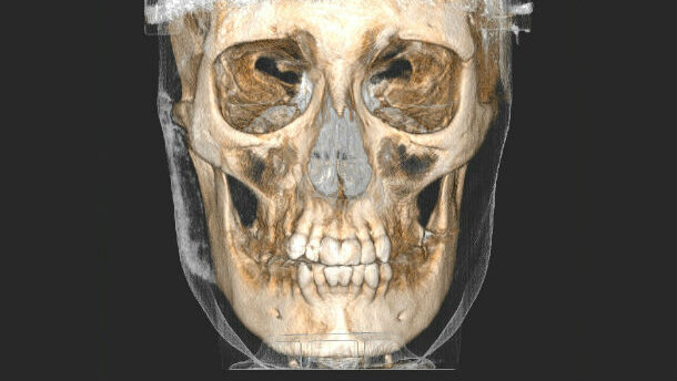 L’introduzione della tecnologia nello studio odontoiatrico: la cone-beam CT